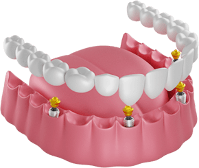 Все зубы на 4 имплантах