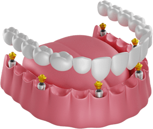 Все зубы на 6 имплантах