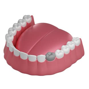 Есть все зубы, нужно удалить